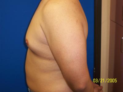 Before Surgery-Side/Left